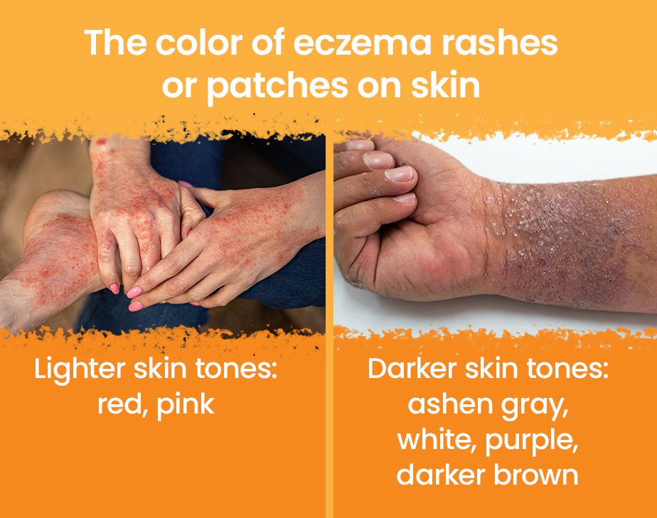 Closeups of 2 different hands showing the color difference of eczema.