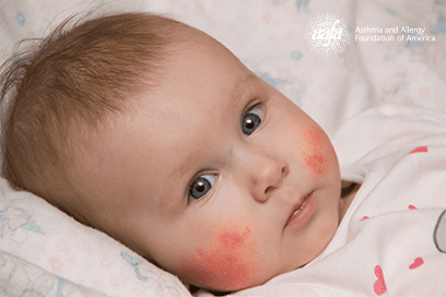 infant eczema